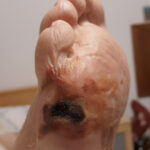 What is Diabetic Foot?