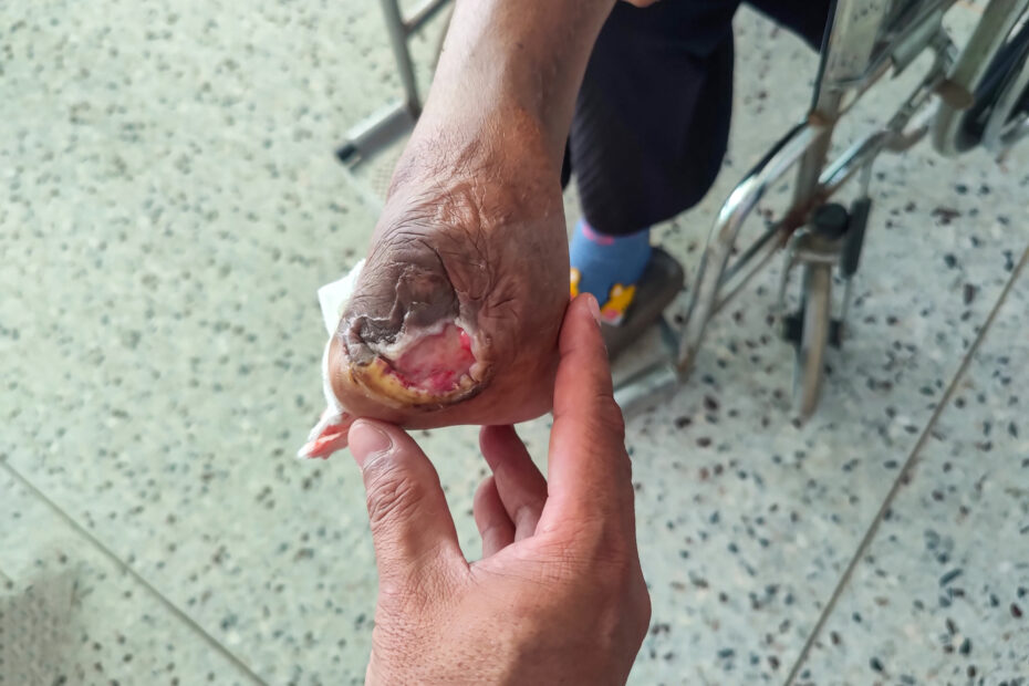 Diabetic Foot Ulcer